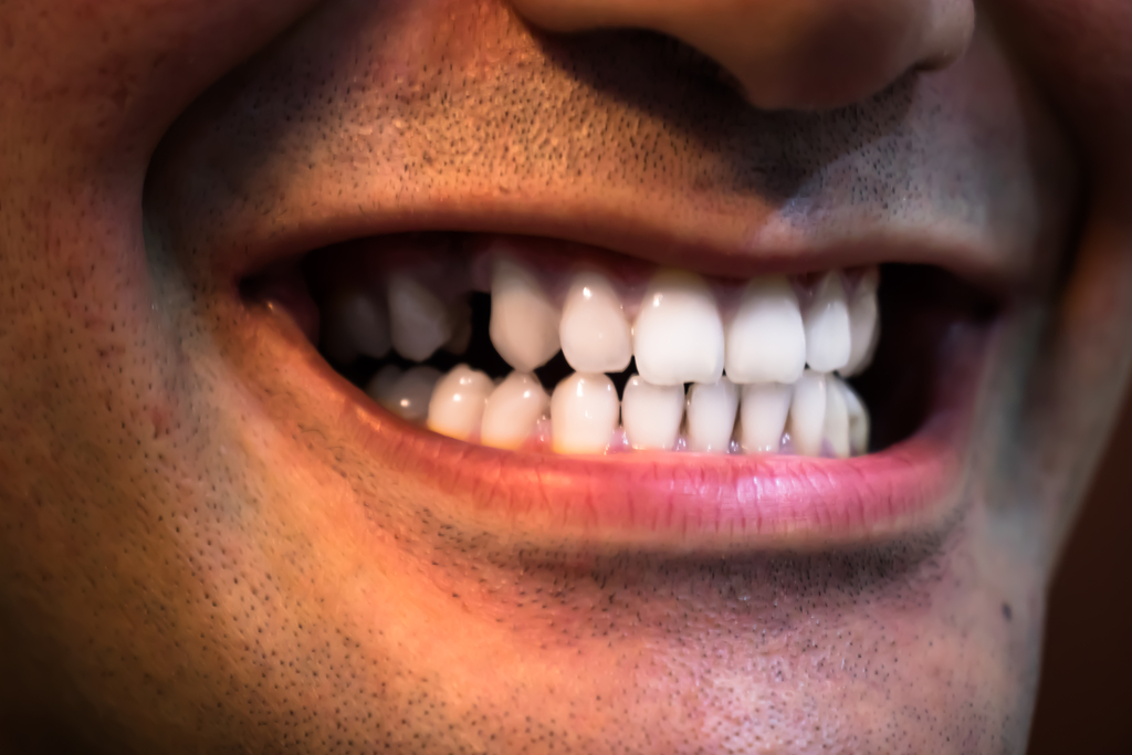 Bruxism Bruxism