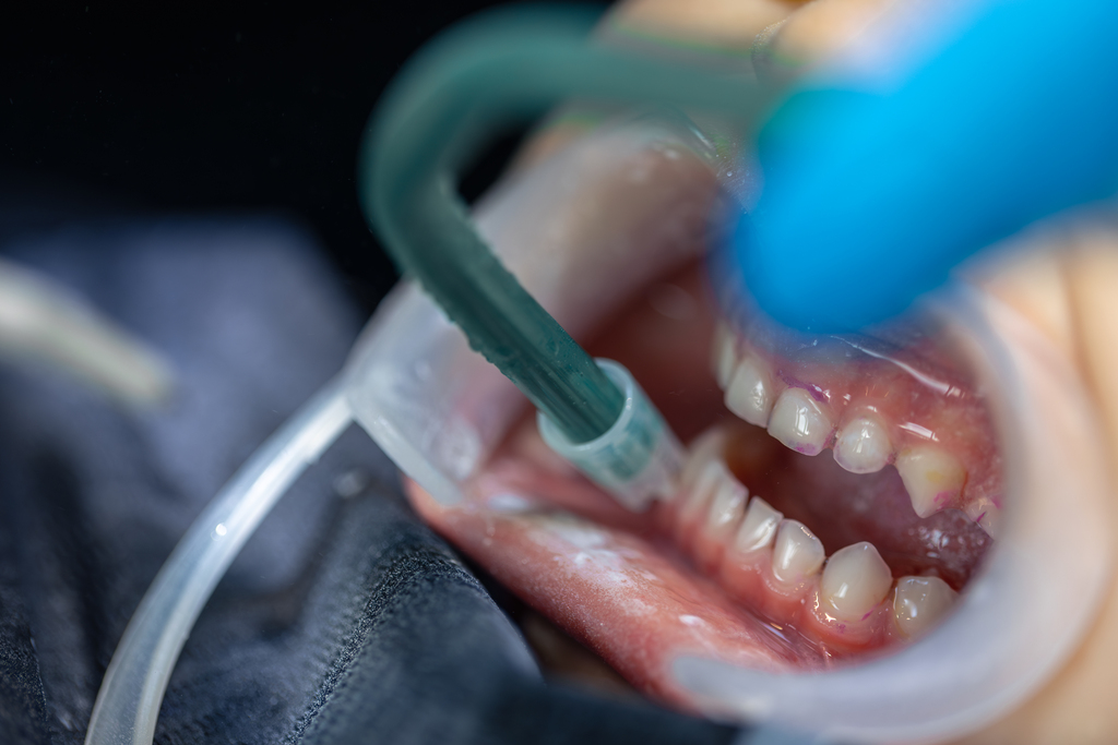 Dental Pocket Irrigation