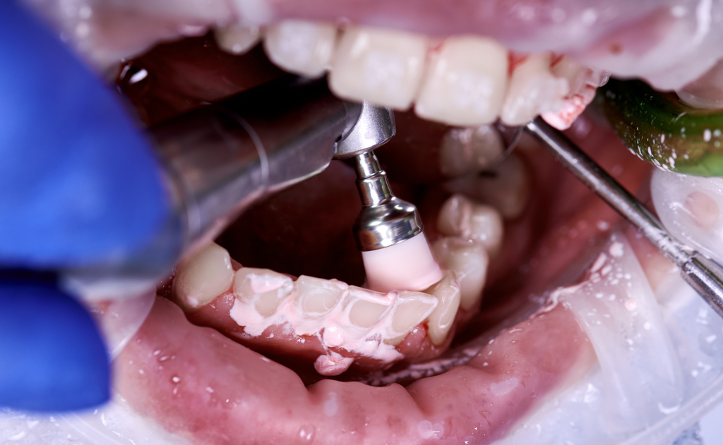 Dental Ridge Modification