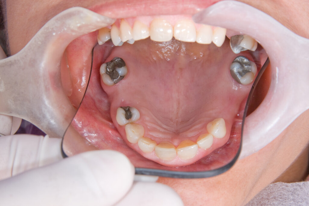 Multiple Tooth Replacement
