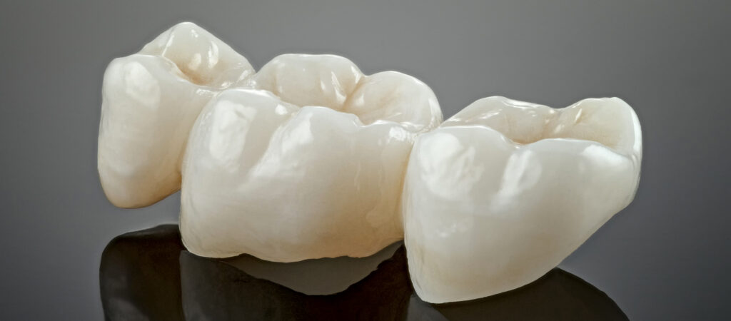 Porcelain Crowns (Caps)