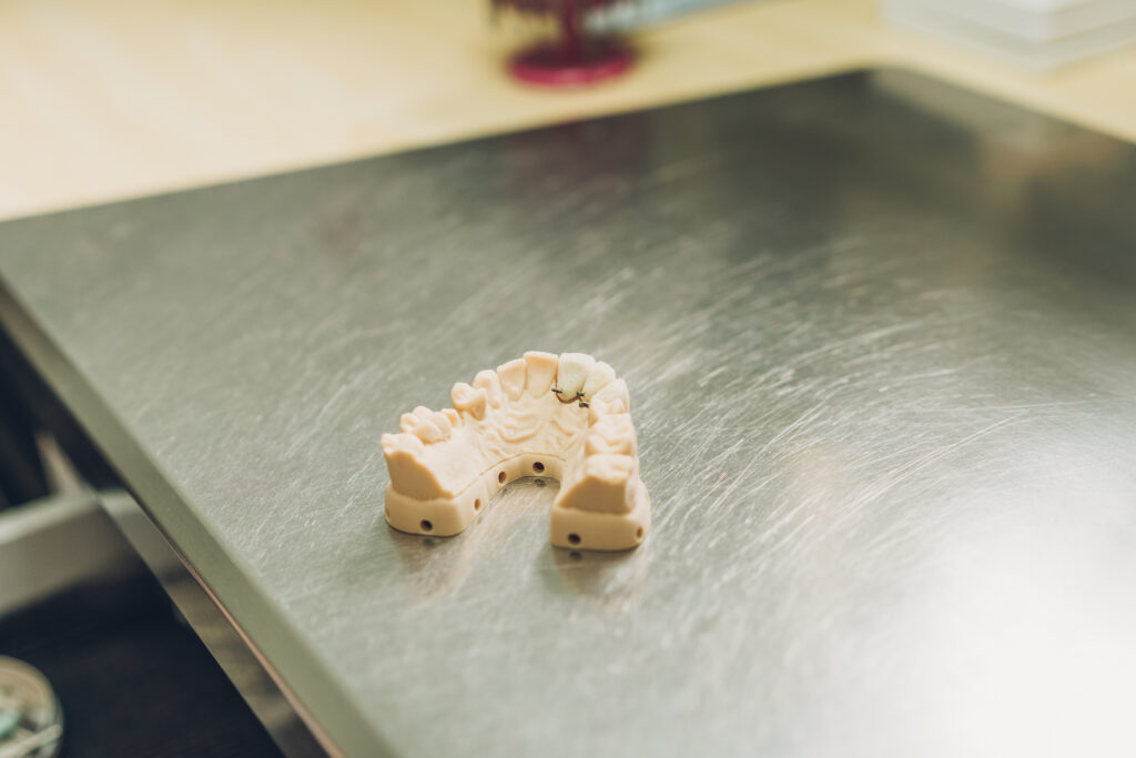 Porcelain Fixed Bridges