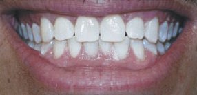 lumalite whitening after image