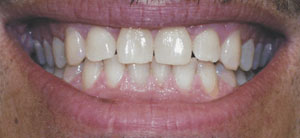 lumalite whitening before image